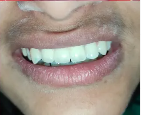After dental treatment