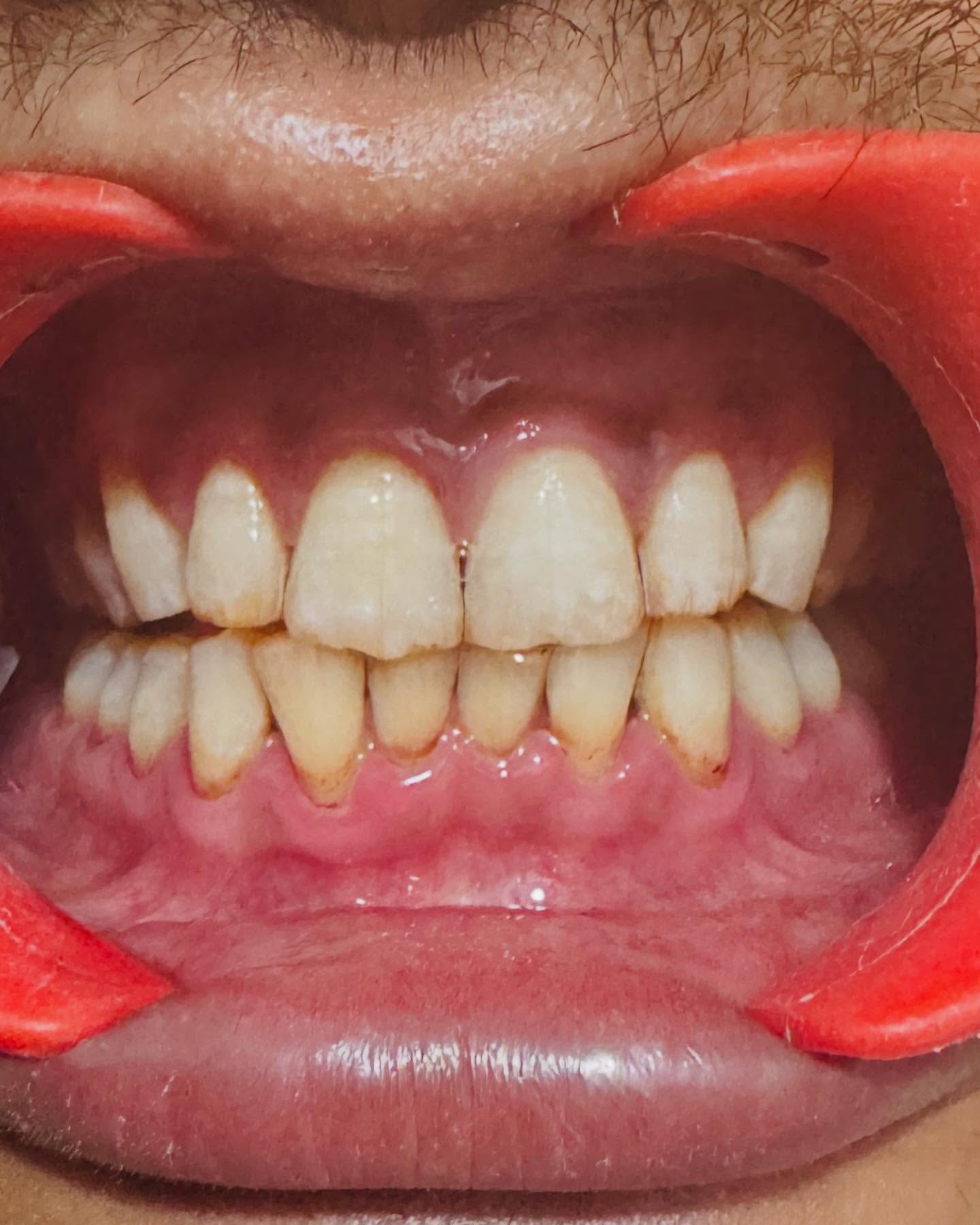 After orthodontic treatment