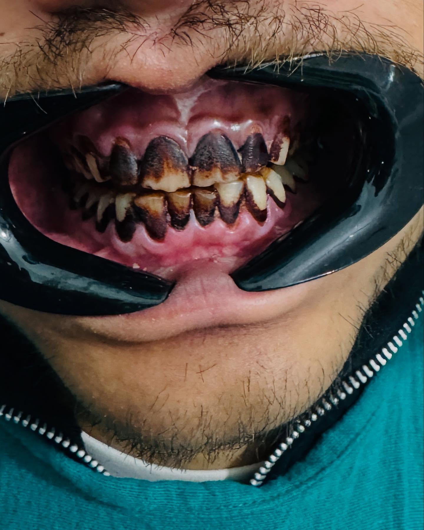 Before orthodontic treatment