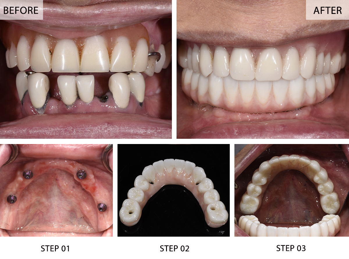 Dental implant before and after comparison
