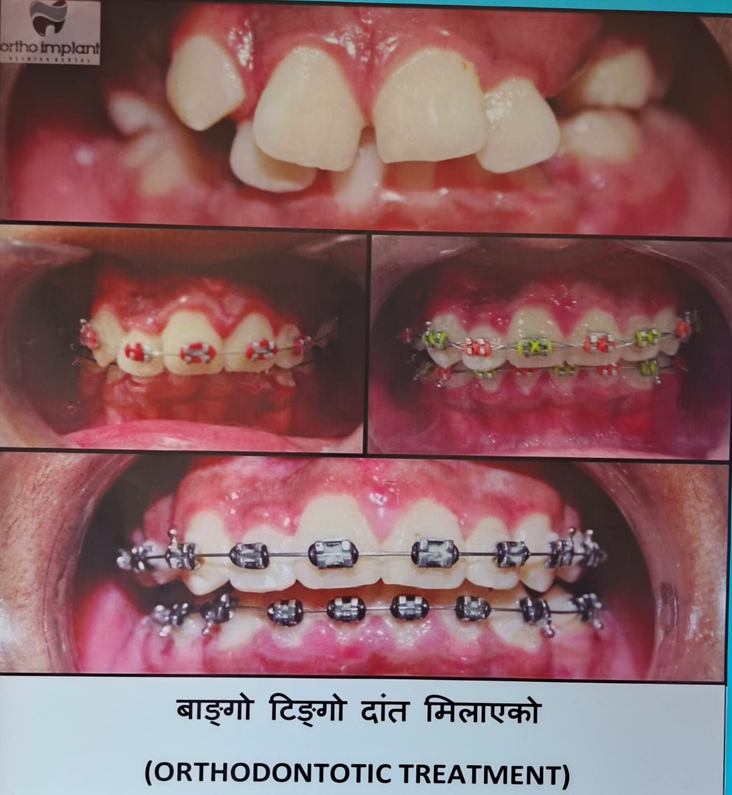 Orthodontic treatment – braces