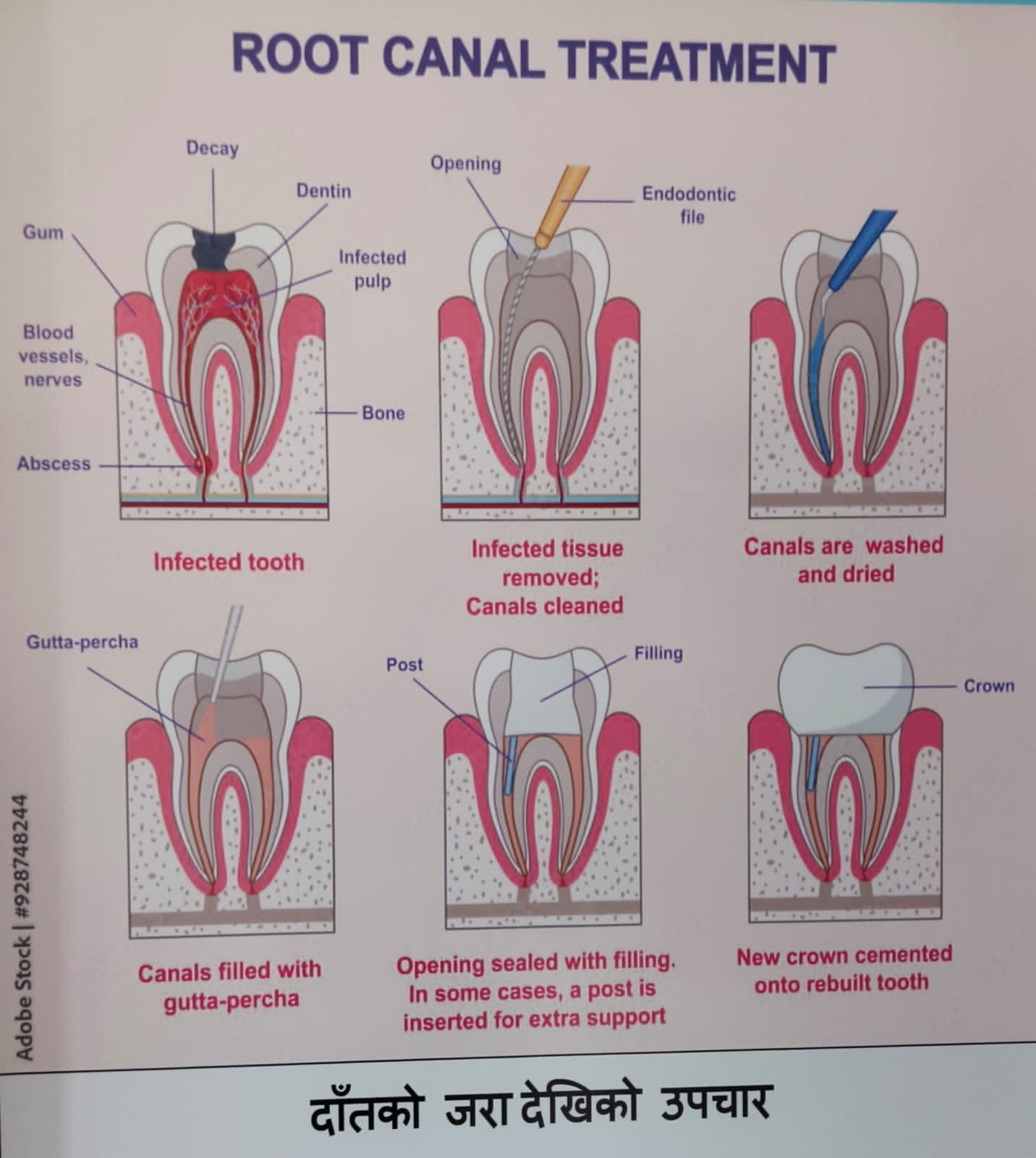 Root canal treatment diagram